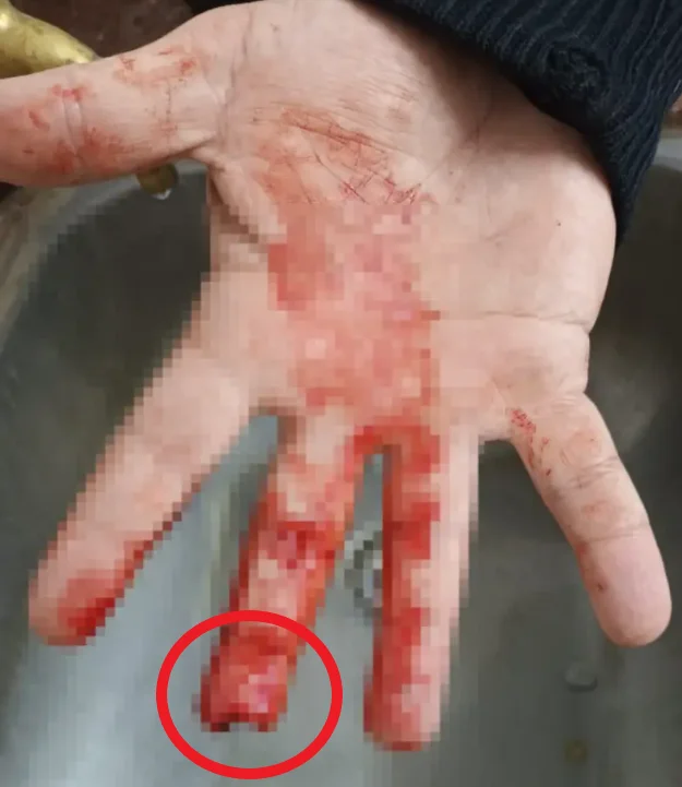 DEDO